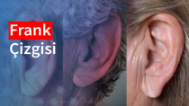 Kulak Memesindeki 'Frank İşareti' Kalp Hastalığı Belirtisi mi?